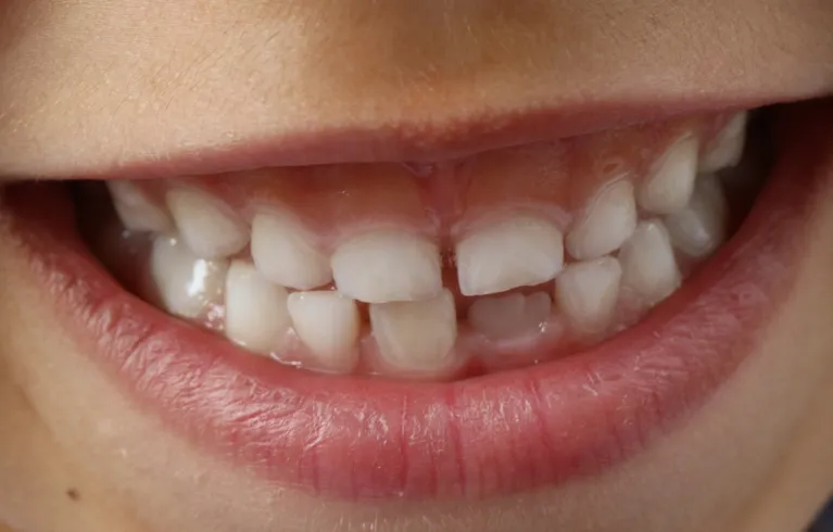 Child Dental Health