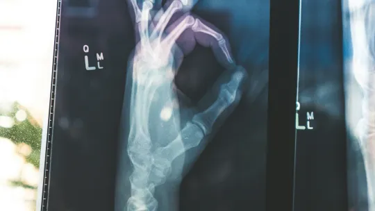 X-ray of hand which looks like it's giving the OK sign